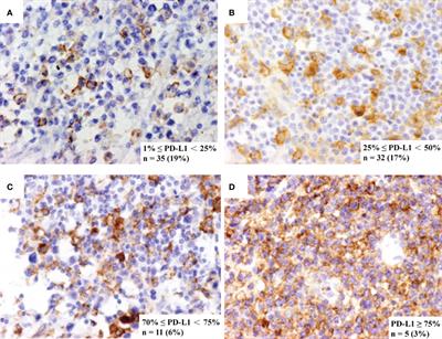 The Role of PD-L1 Expression in Prediction and Stratification of Recurrent or Refractory Extranodal Natural Killer/T-Cell Lymphoma